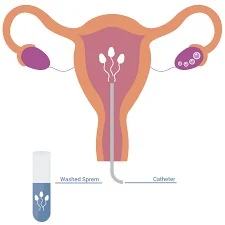 IUI (Intrauterine Insemination)
