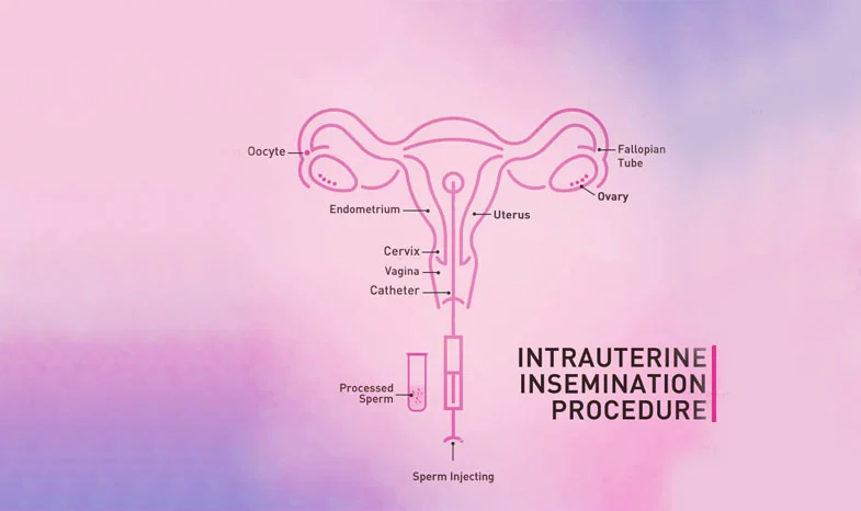 IUI